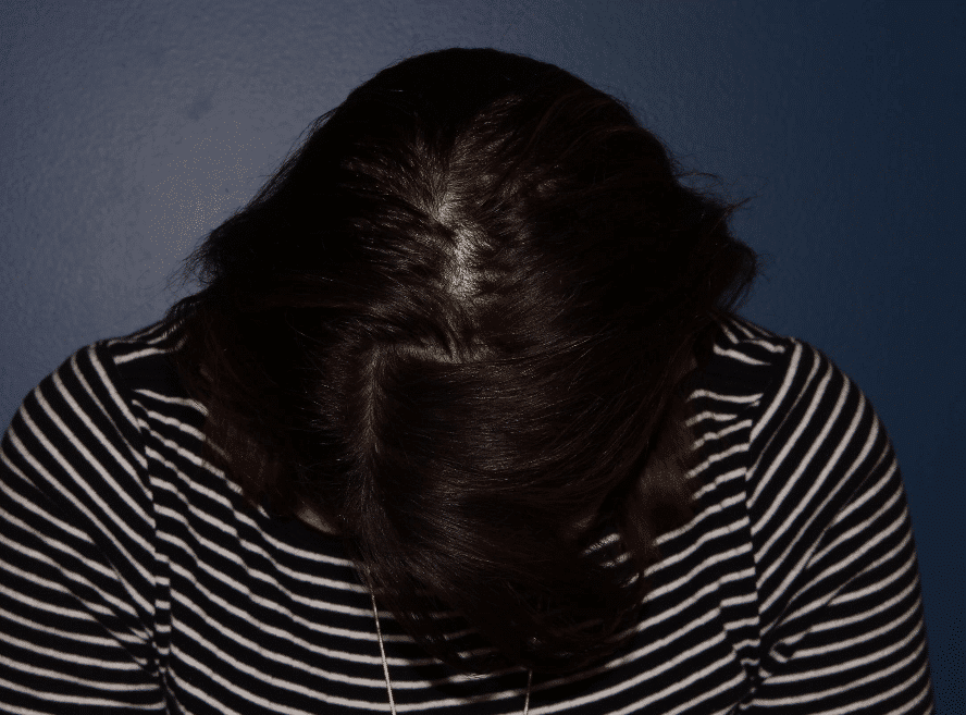 Before Image: Hair PRP - front