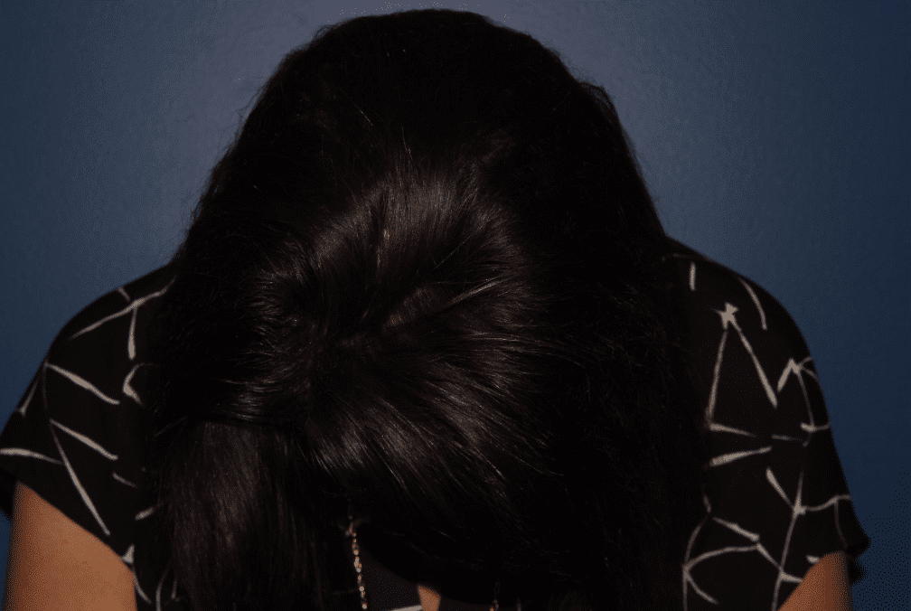 After Image: Hair PRP - front