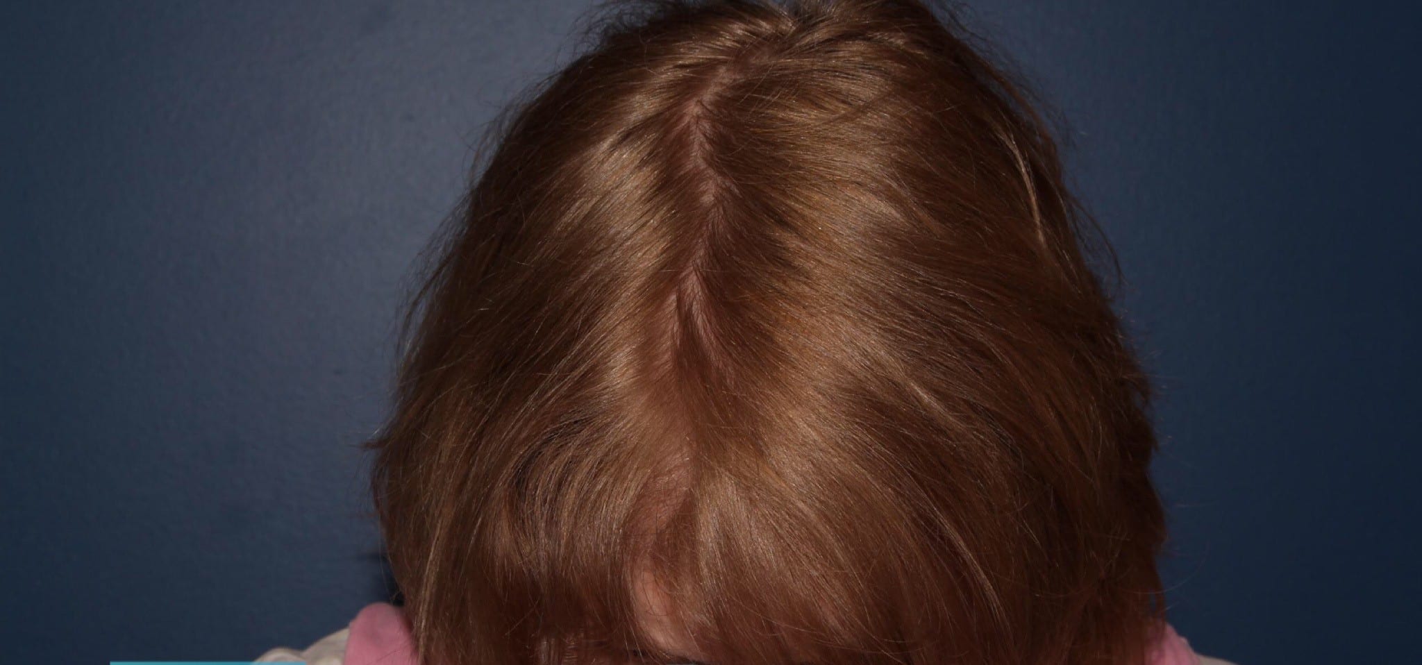 Before Image: Hair PRP - front