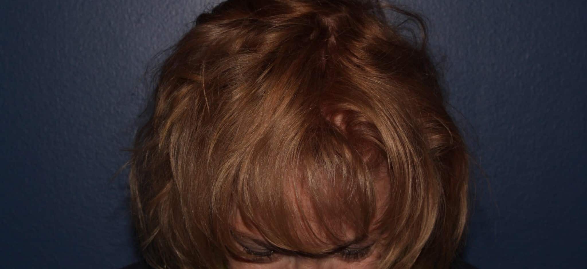 After Image: Hair PRP - front