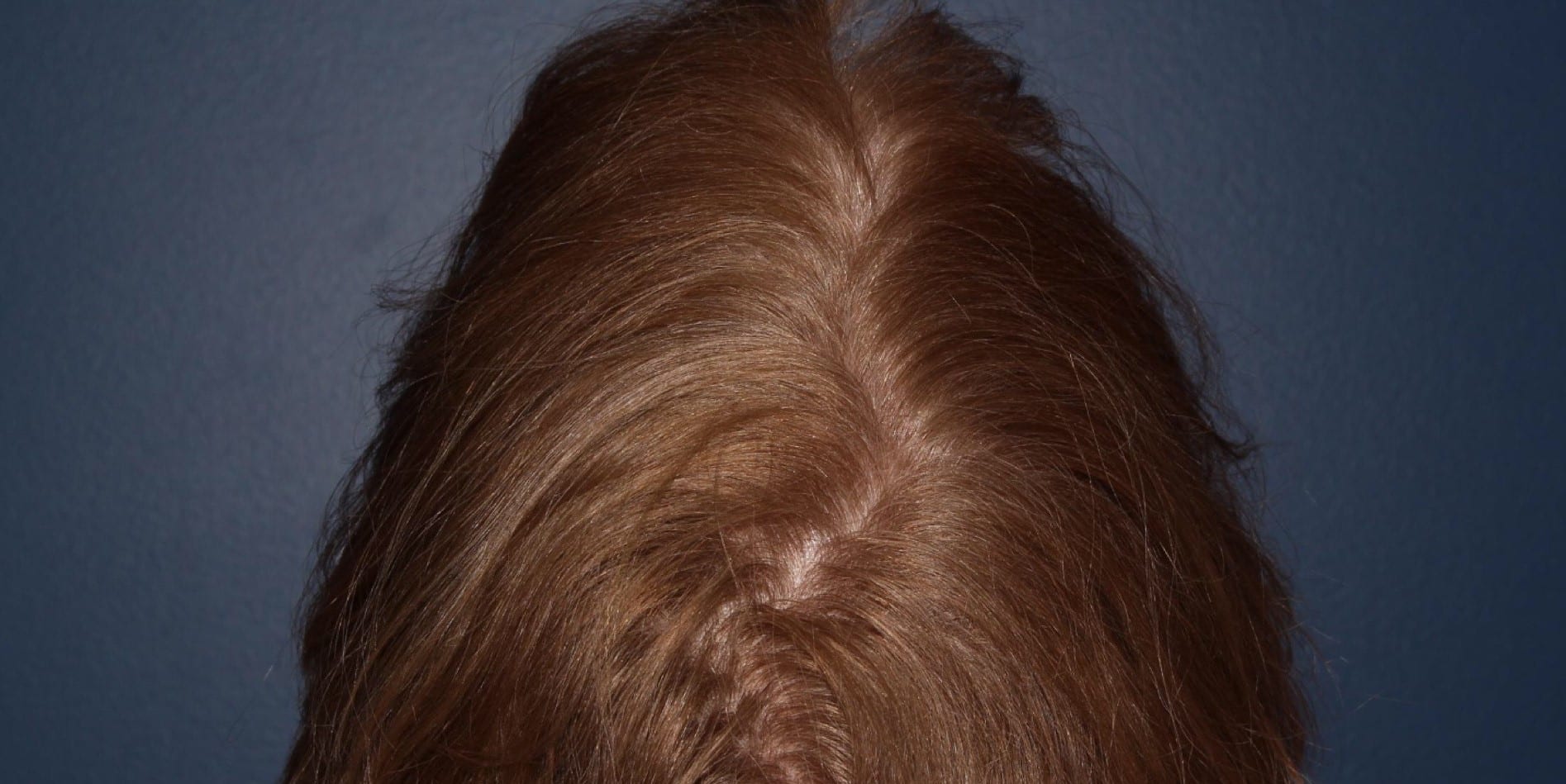 Before Image: Hair PRP - back