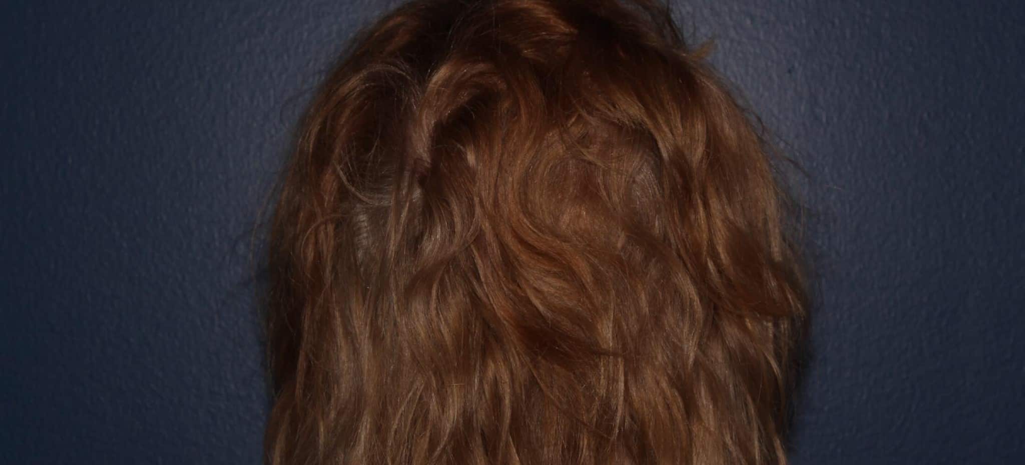 After Image: Hair PRP - back