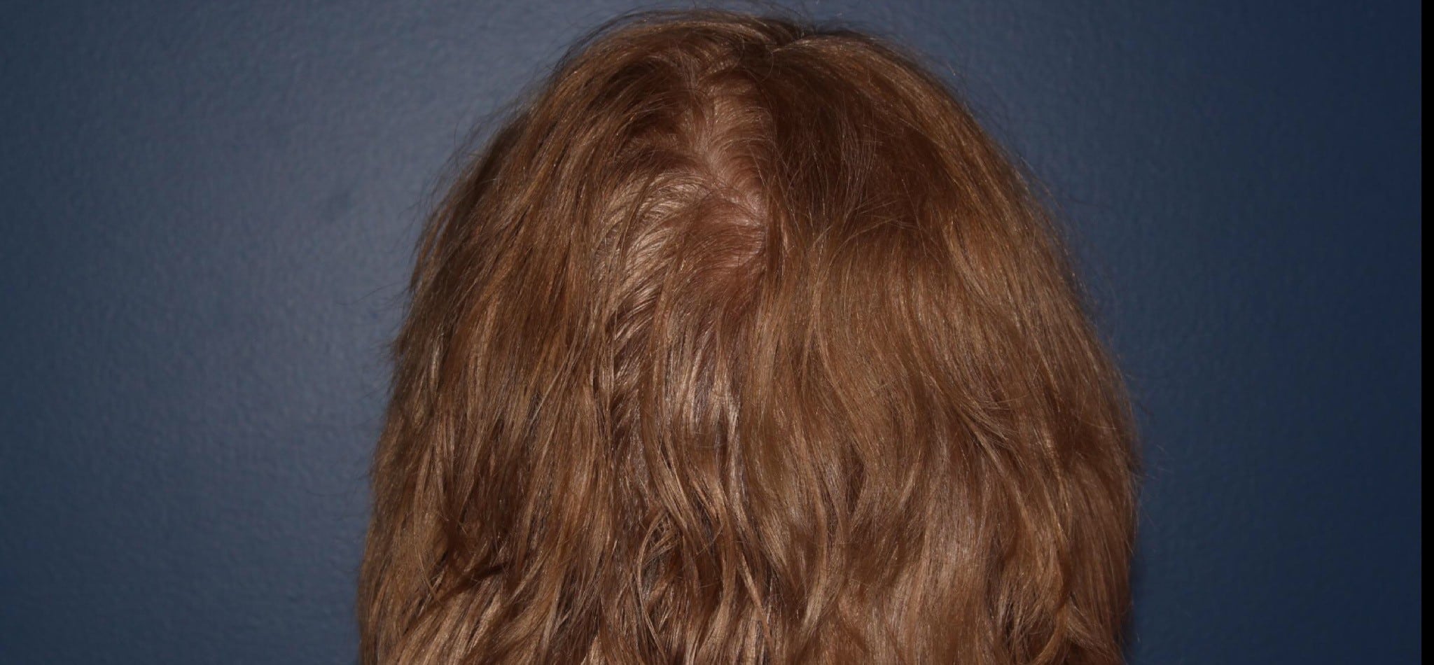 Before Image: Hair PRP - back