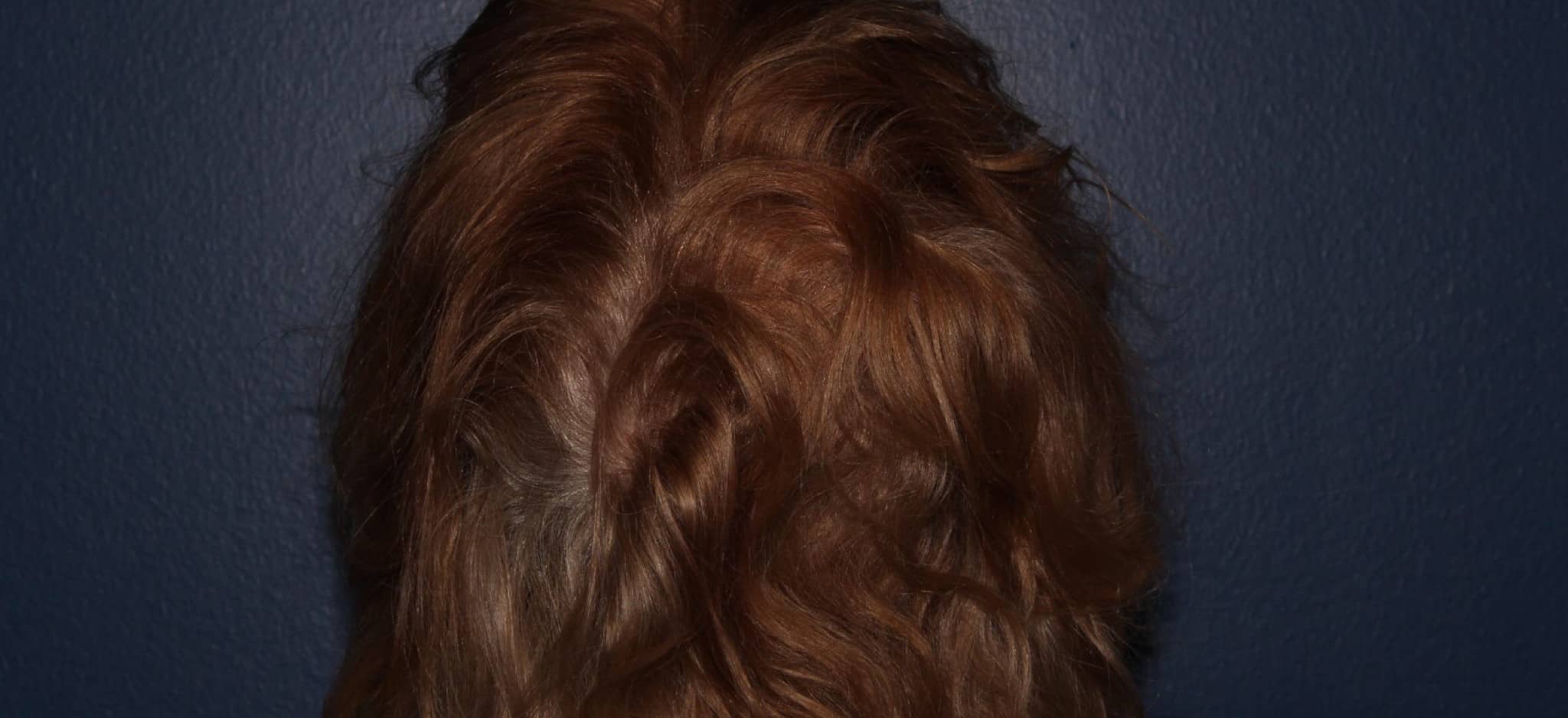 After Image: Hair PRP - back