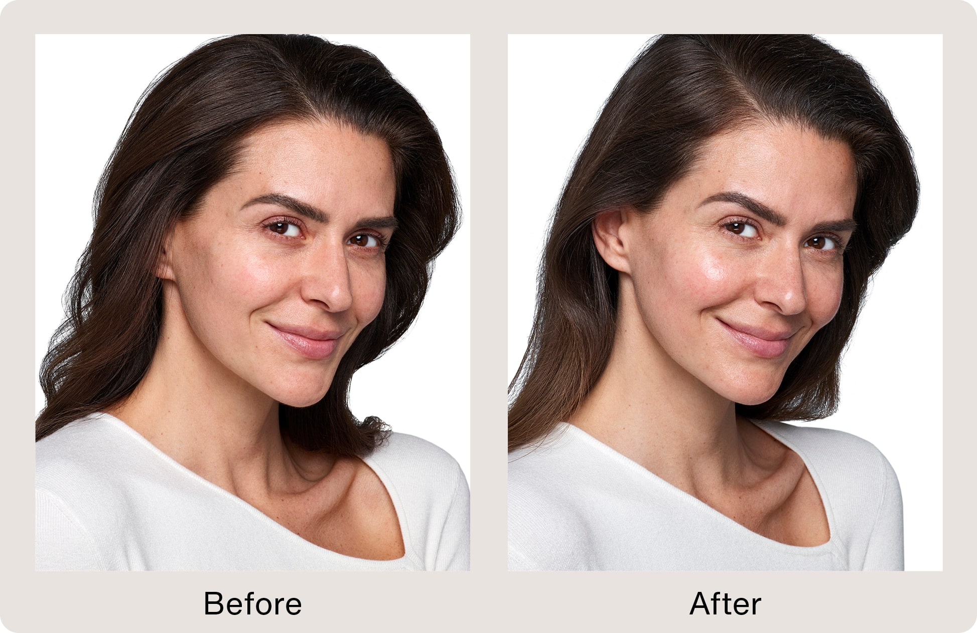 Before and After Juvederm Swansea IL Before and After Juvederm Swansea IL