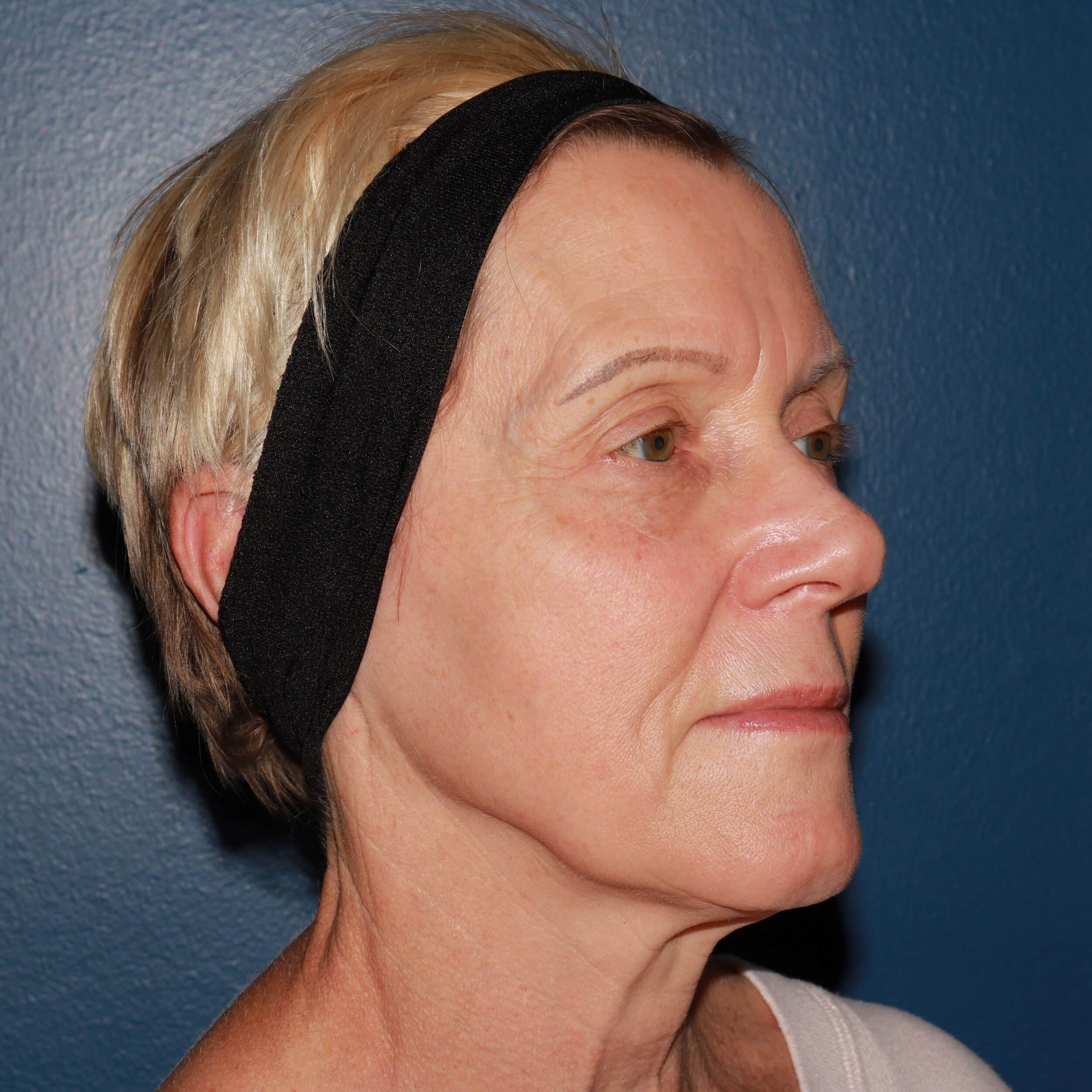 After Image: BBL Forever Young - right-front-oblique