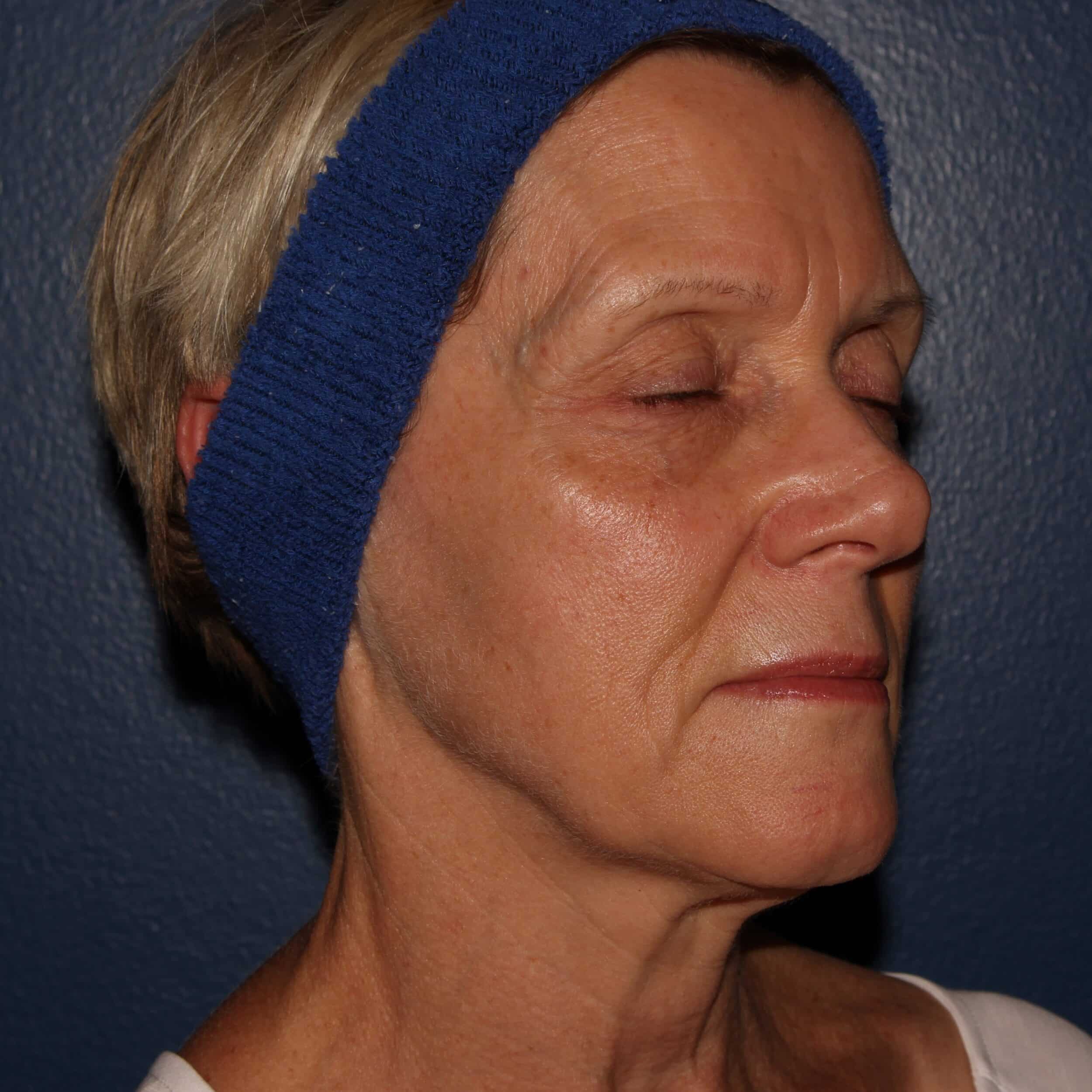 Before Image: BBL Forever Young - right-front-oblique