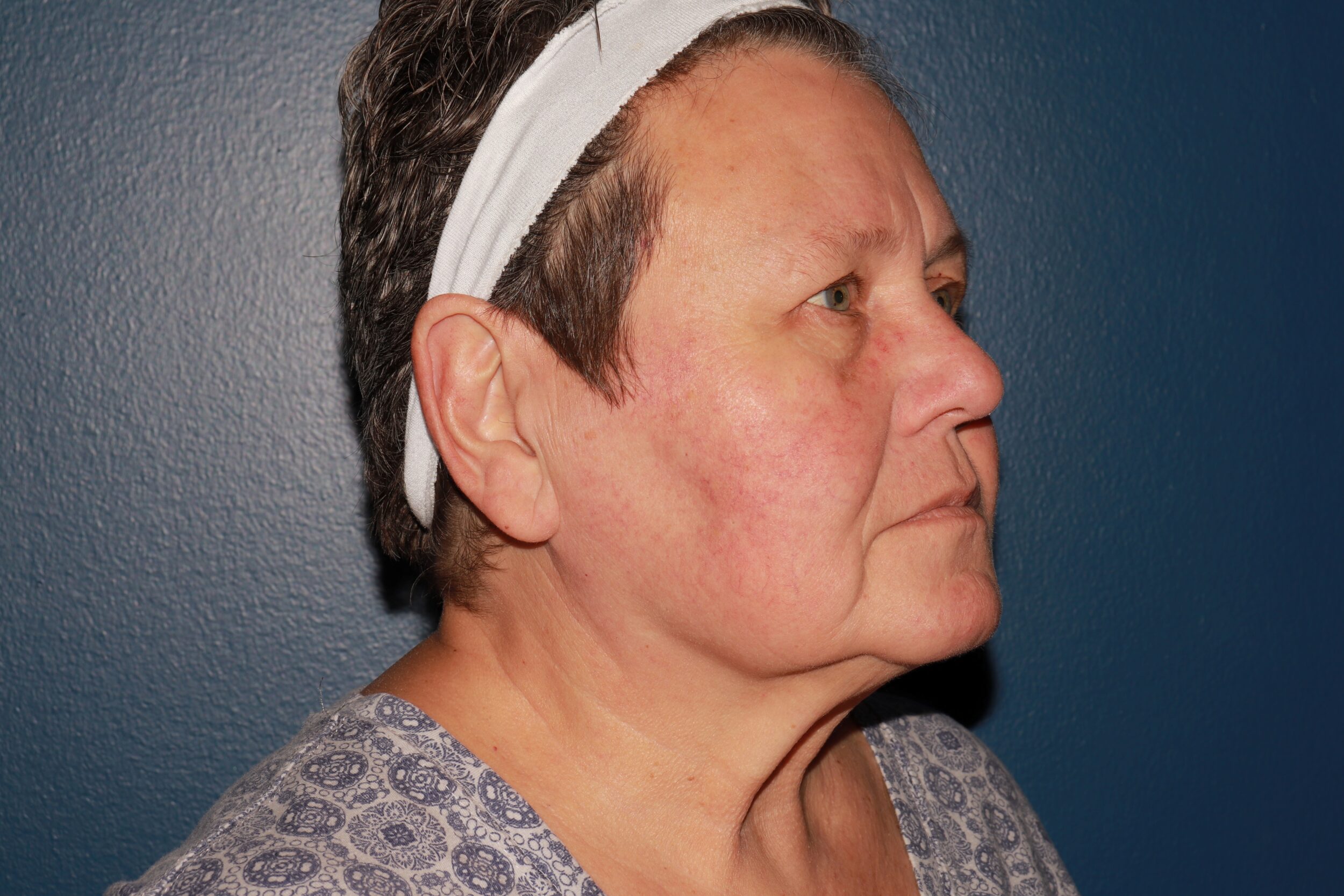 After Image: BBL – Red Vessels - front