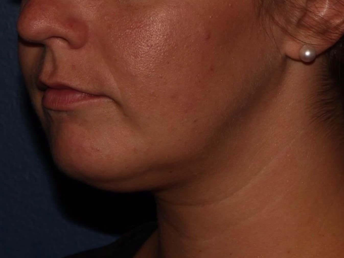After Image: CoolSculpting - left-front-oblique