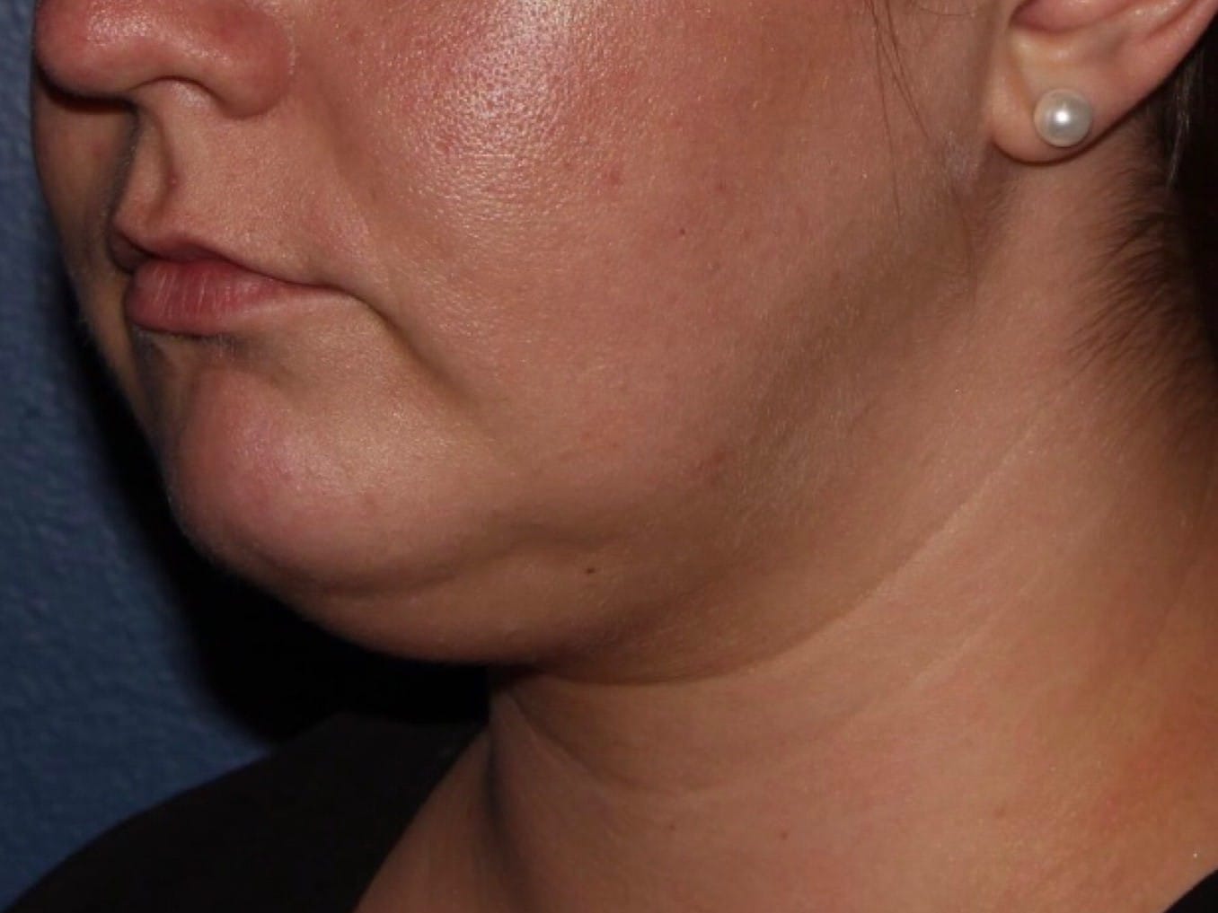 Before Image: CoolSculpting - left-front-oblique
