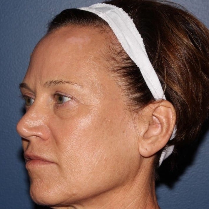 Before Image: Secret RF - left-front-oblique