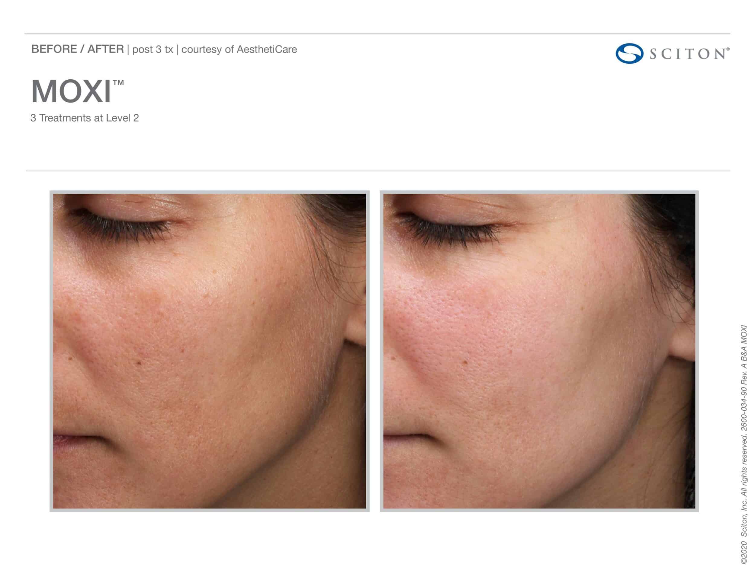 Before and After MOXI Treatment Swansea IL Before and After MOXI Treatment Swansea IL