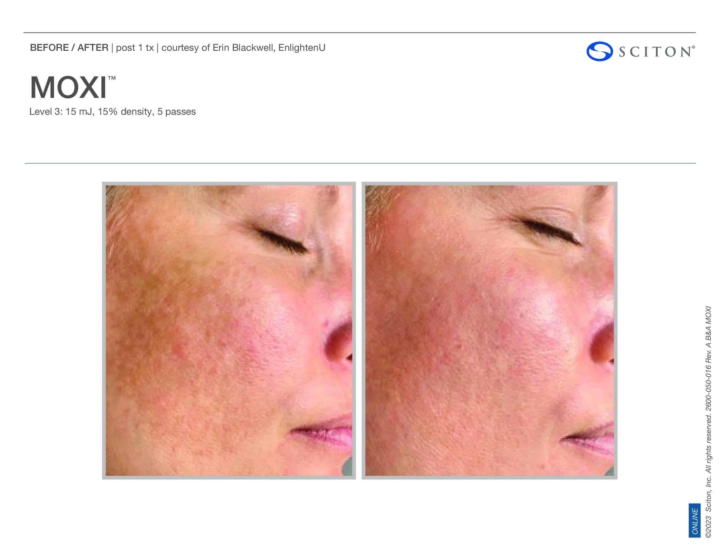 Before and After MOXI Swansea IL Before and After MOXI Swansea IL