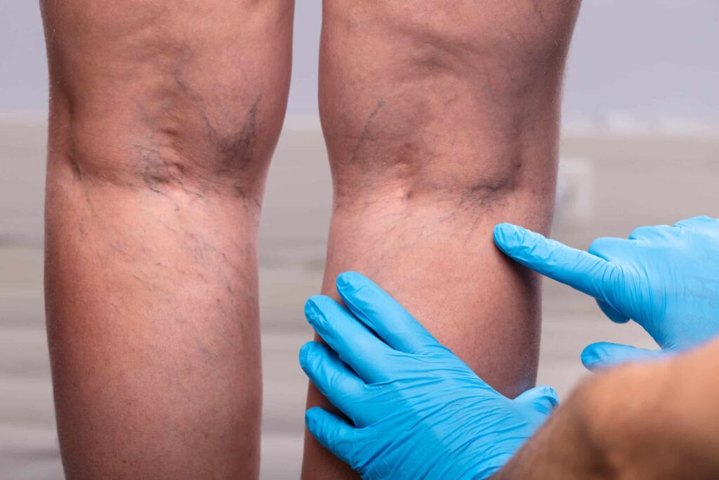 Doctor examining a patient's legs before sclerotherapy treatment for spider veins