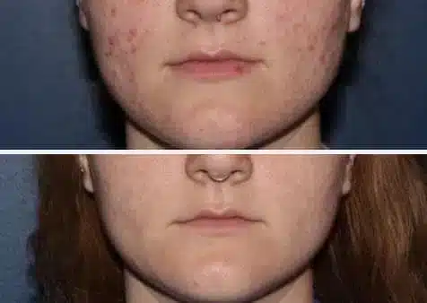 case1-1.jpg Acne Treatment in Swansea, IL