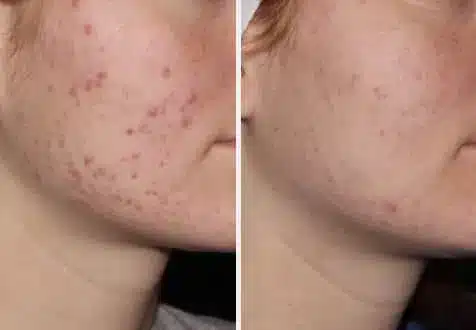 case1-2.jpg Acne Treatment in Swansea, IL