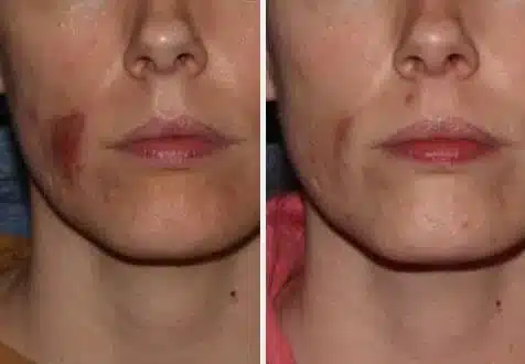 case2-1.jpg Acne Treatment in Swansea, IL