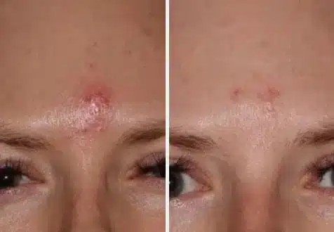 case2-2.jpg Acne Treatment in Swansea, IL