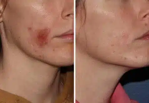 case2-3.jpg Acne Treatment in Swansea, IL