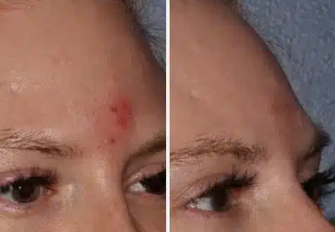 case2-4.jpg Acne Treatment in Swansea, IL