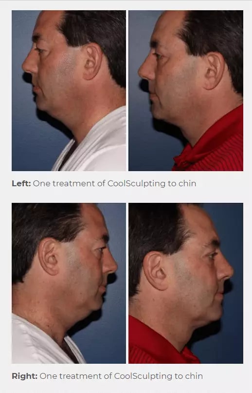 1-1 CoolSculpting