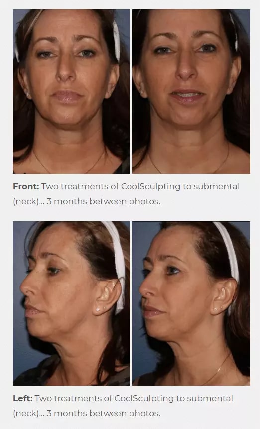 2-1-1 CoolSculpting