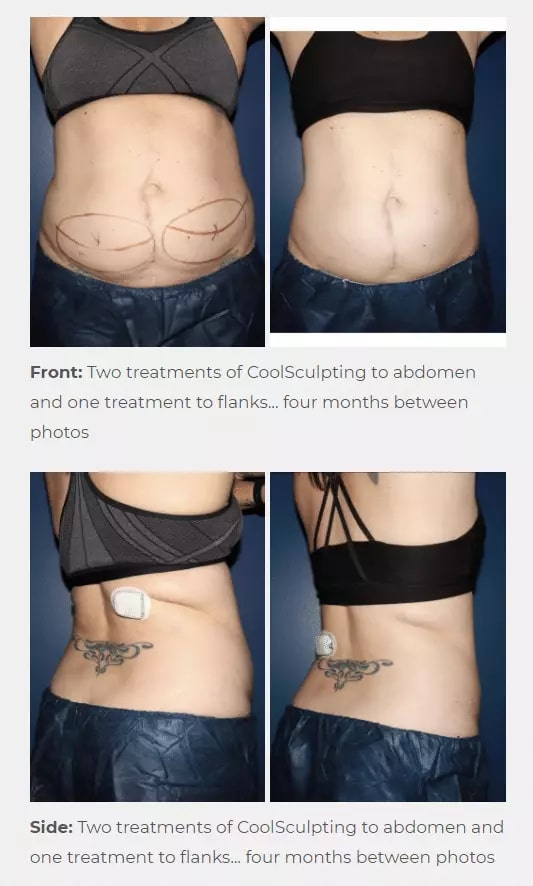 3-1-1 CoolSculpting