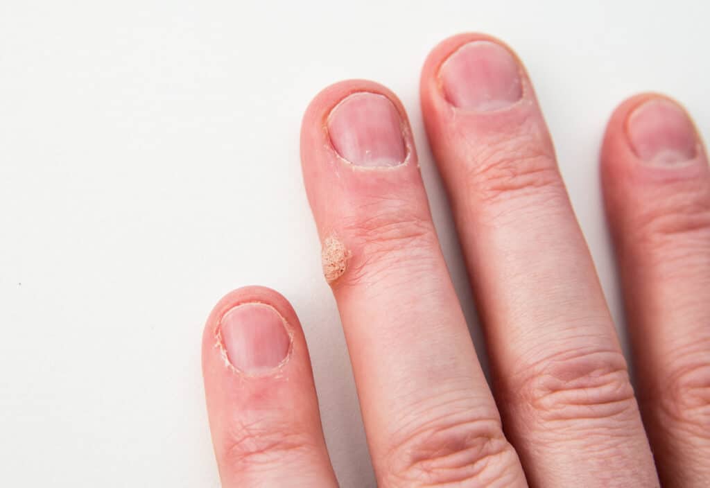 Close-up of a raised, rough-textured wart on the side of a finger near the nail.
