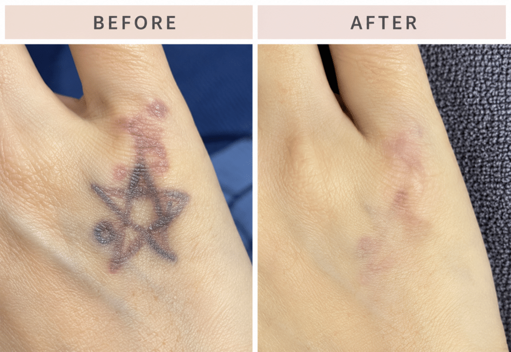 Tattoo Removal PICOFY LASER IN SWANSEA, IL