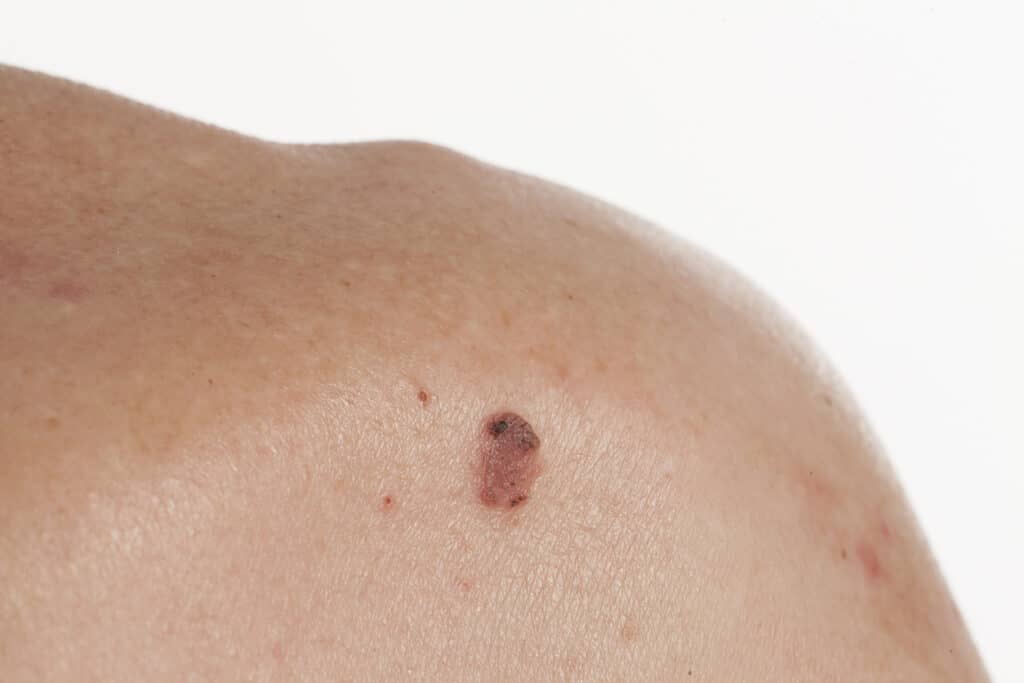 Close-up of a patient's shoulder with a cancerous skin growth, in need of GentleCure radiation treatment.