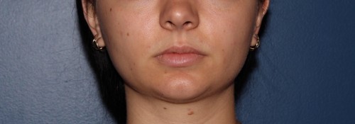 Kybella before and after | Swansea IL