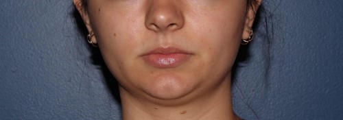Kybella before and after | Swansea IL