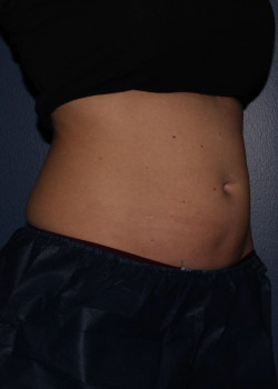 CoolSculpting – abdomen after photo. Individual results may vary.