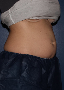 CoolSculpting – abdomen before photo. Individual results may vary.