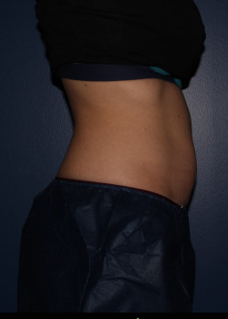 CoolSculpting – abdomen after photo. Individual results may vary.