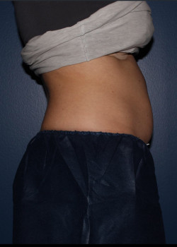 CoolSculpting – abdomen before photo. Individual results may vary.