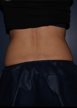 CoolSculpting – abdomen after photo. Individual results may vary.