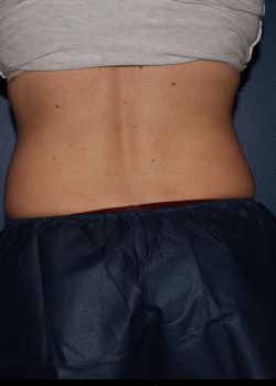 CoolSculpting – abdomen before photo. Individual results may vary.