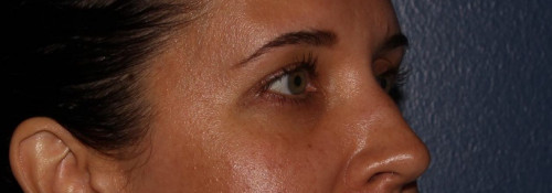 Versa – tear troughs before photo. Individual results may vary.