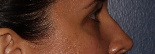Versa – tear troughs before photo. Individual results may vary.