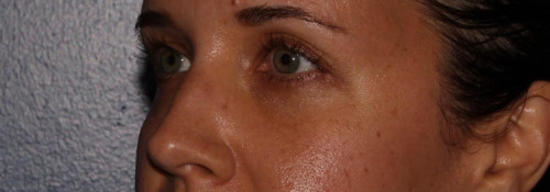 Versa – tear troughs before photo. Individual results may vary.