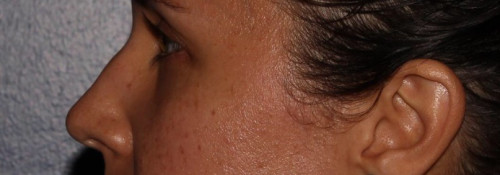 Versa – tear troughs before photo. Individual results may vary.