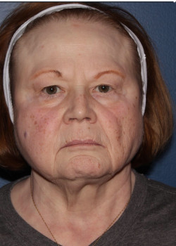 BBL Forever Young – full face before photo. Individual results may vary.
