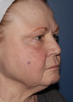 BBL Forever Young – full face before photo. Individual results may vary.