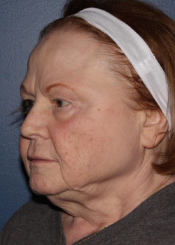 BBL Forever Young – full face before photo. Individual results may vary.