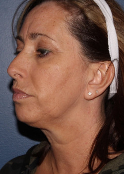 Coolsculpting mini – submental (neck) area before photo. Individual results may vary.