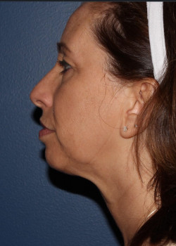 Coolsculpting mini – submental (neck) area after photo. Individual results may vary.