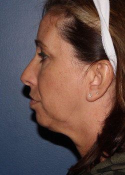 Coolsculpting mini – submental (neck) area before photo. Individual results may vary.
