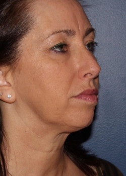 Coolsculpting mini – submental (neck) area after photo. Individual results may vary.
