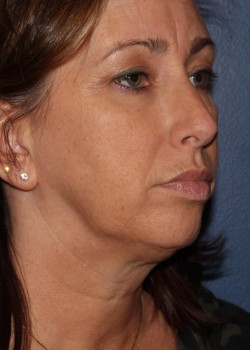 Coolsculpting mini – submental (neck) area before photo. Individual results may vary.